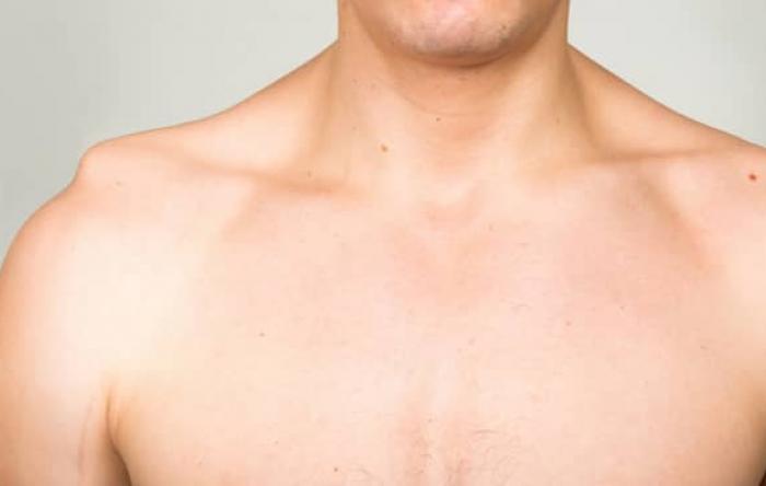 گسستگی شانه