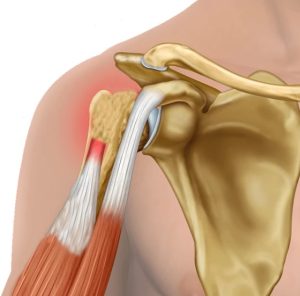 درمان غیرجراحی پارگی تاندون و ساییدگی شانه با روش پی آر پی (PRP) در کرج
